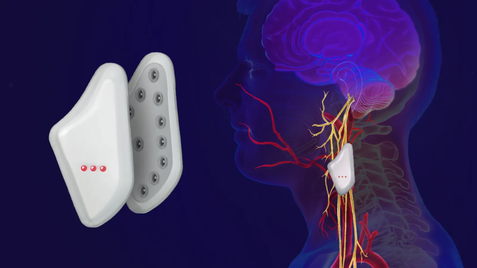 Realistic rendered ¾ view of seizure implant with placement diagram within the human body