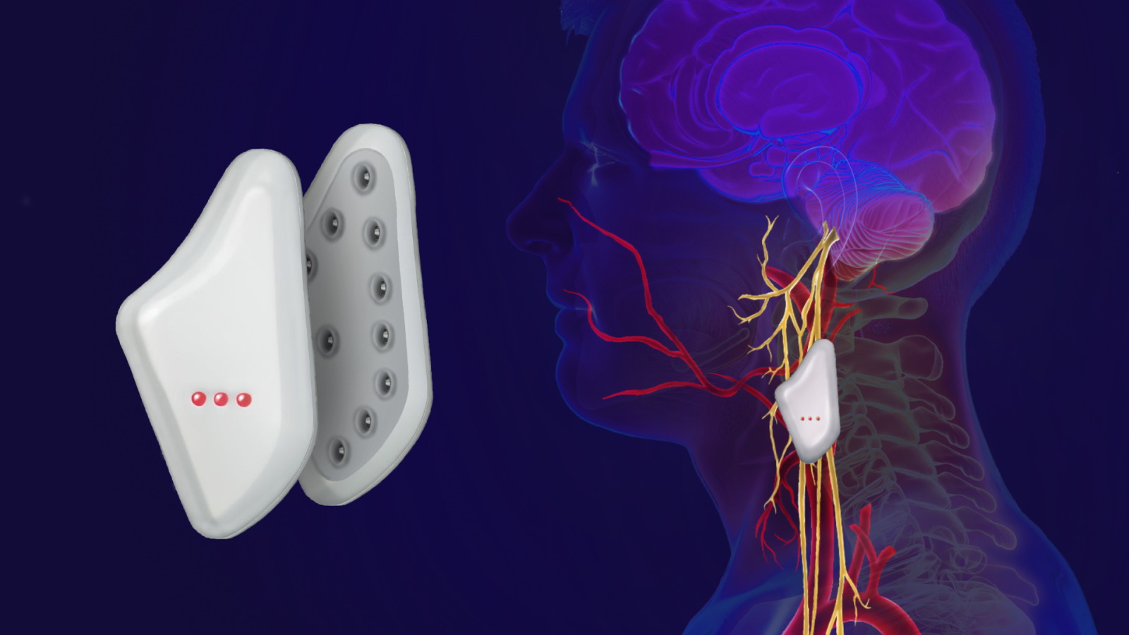 Realistic rendered ¾ view of seizure implant with placement diagram within the human body