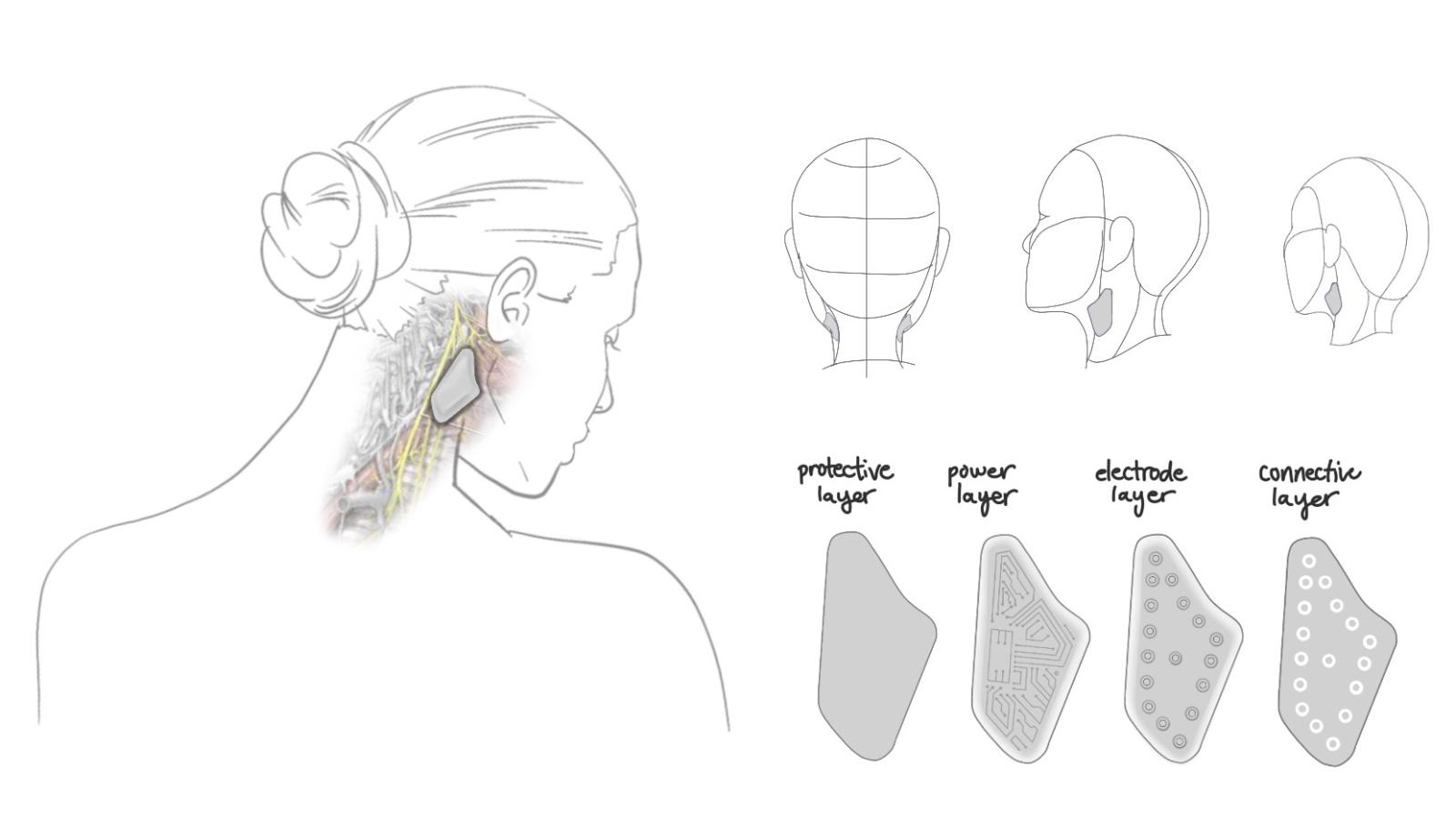 Product sketches of implant in beginning stages of development